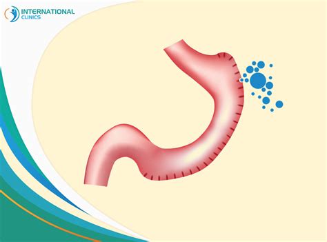 signs of gastric sleeve leak|Gastric Sleeve Leak Symptoms: Know the Signs